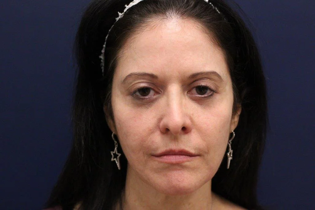 Portrait of a woman with a refined facial profile highlighting with filler services