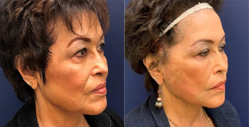 Mint Threads Before and After Photo by Rejuvalife Vitality Institute in Beverly Hills