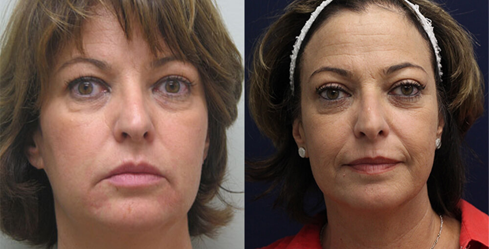 Non Surgical Facial Rejuvenation Before and After Photo by Rejuvalife Vitality Institute in Los Angeles