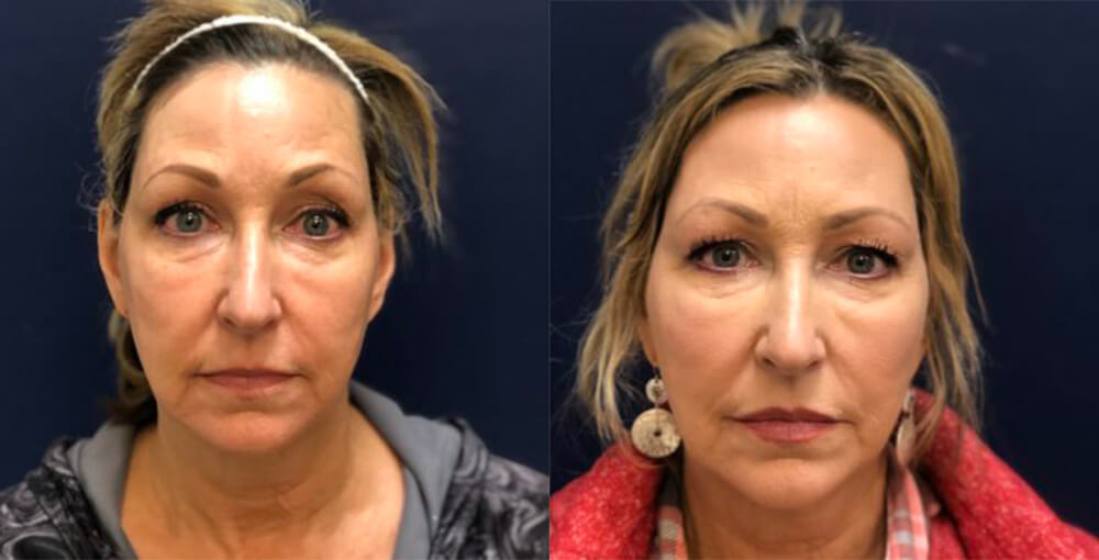 MINT threadlift Before and After Photo by Rejuvalife Vitality Institute in Los Angeles