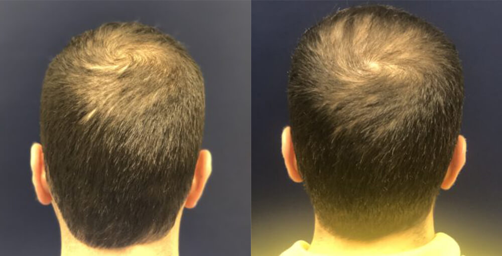 PRP For Hair Loss Before and After Photo by Rejuvalife Vitality Institute in Beverly Hills