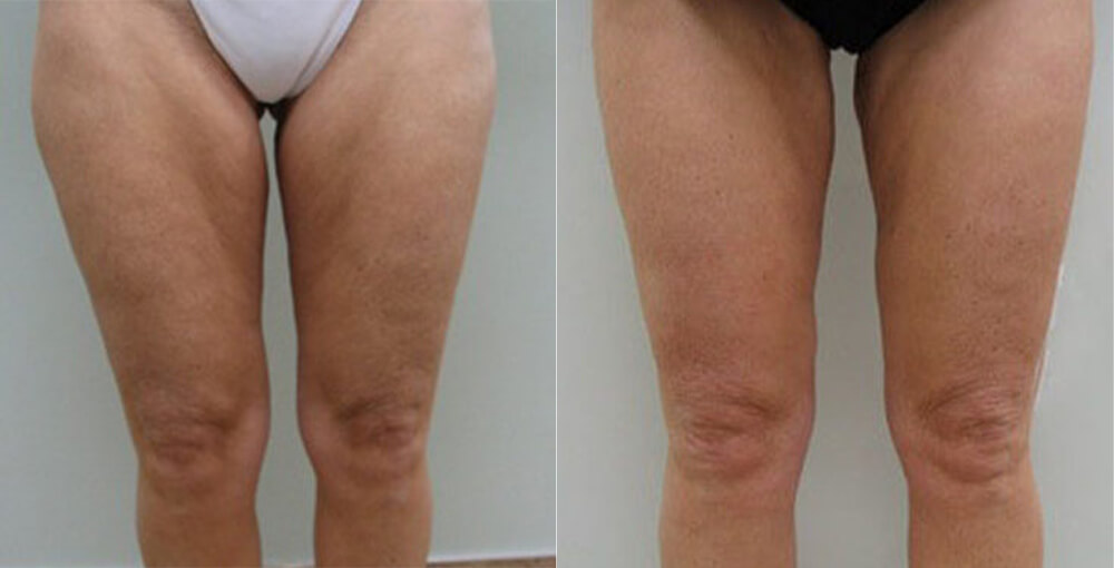 Arms / Legs Before and After Photo by Rejuvalife Vitality Institute in Beverly Hills