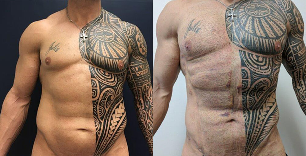 Male Body Sculpting Before and After Photo by Rejuvalife Vitality Institute in Beverly Hills