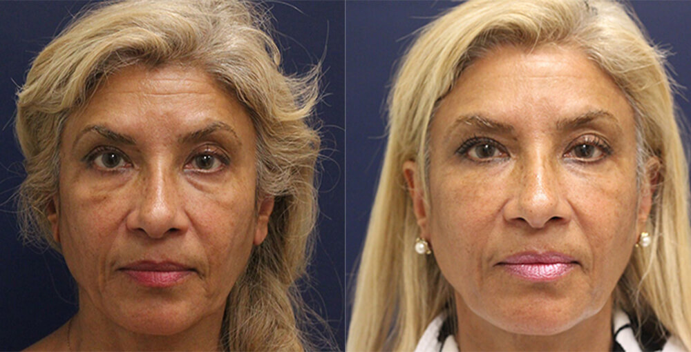 Bellafill Before and After Photo by Rejuvalife Vitality Institute in Beverly Hills