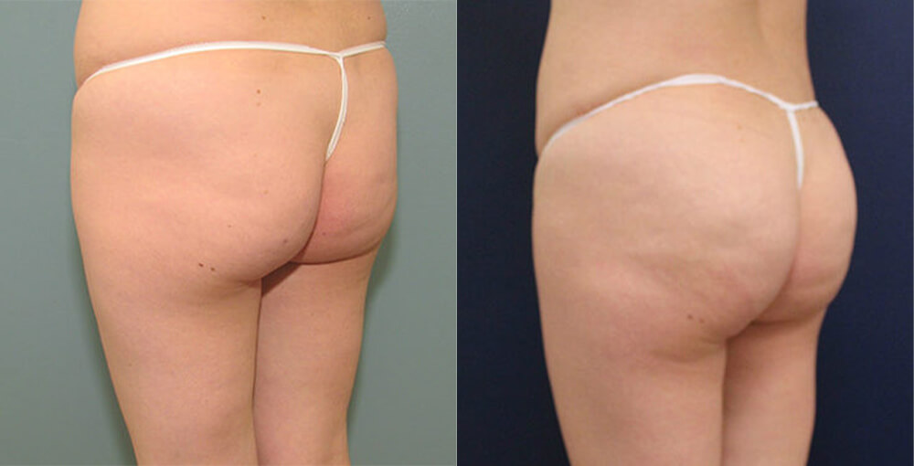 Silhouette Buttlift with Threads Before and After Photo by Rejuvalife Vitality Institute in Beverly Hills