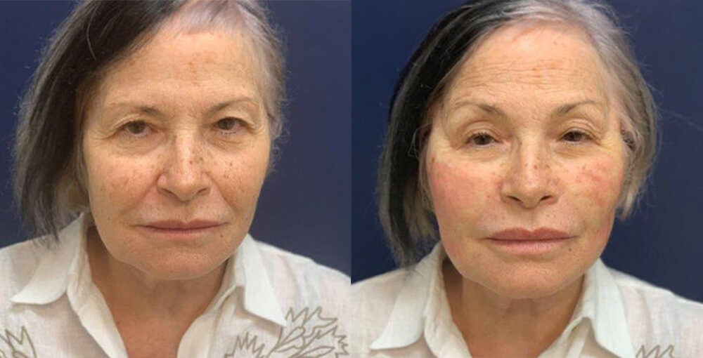 Threadlift Treatment Before and After Photo by Rejuvalife Vitality Institute in Los Angeles