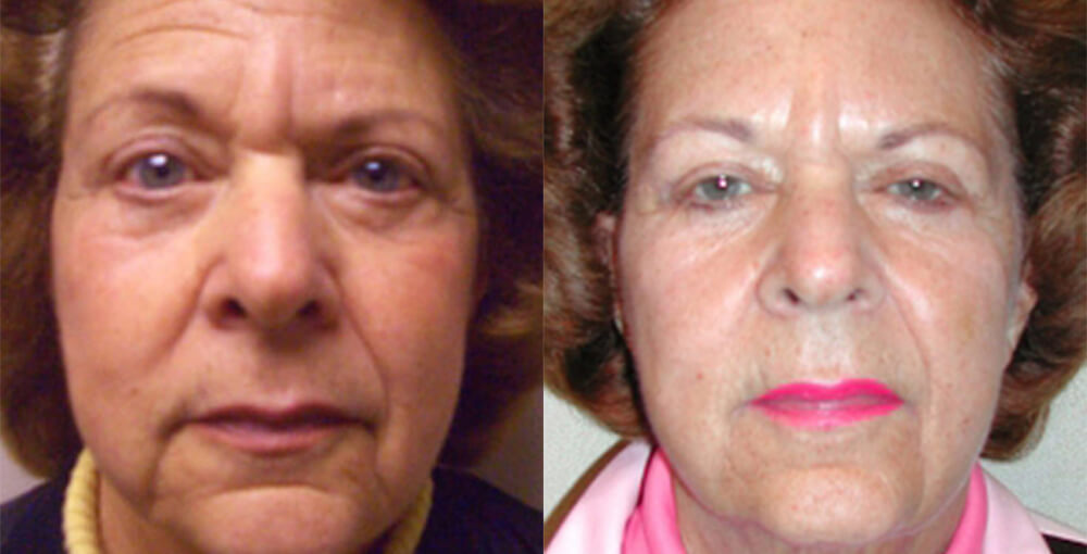 Threadlift Treatment Before and After Photo by Rejuvalife Vitality Institute in Los Angeles
