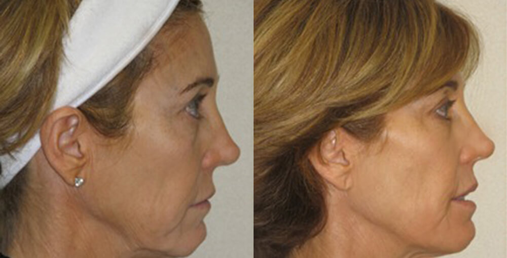 Smartlipo with Precision TX Before and After Photo by Rejuvalife Vitality Institute in Los Angeles