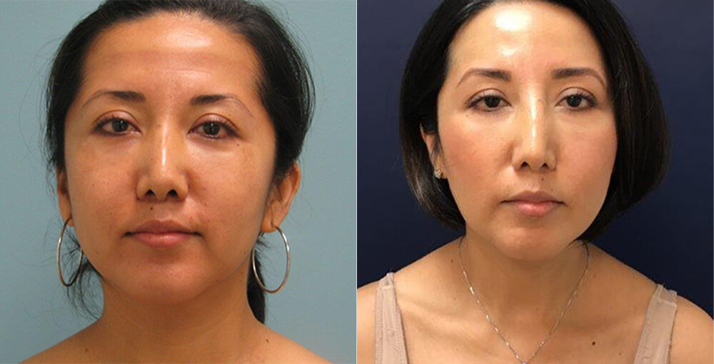 Smartlipo with Precision TX Before and After Photo by Rejuvalife Vitality Institute in Los Angeles