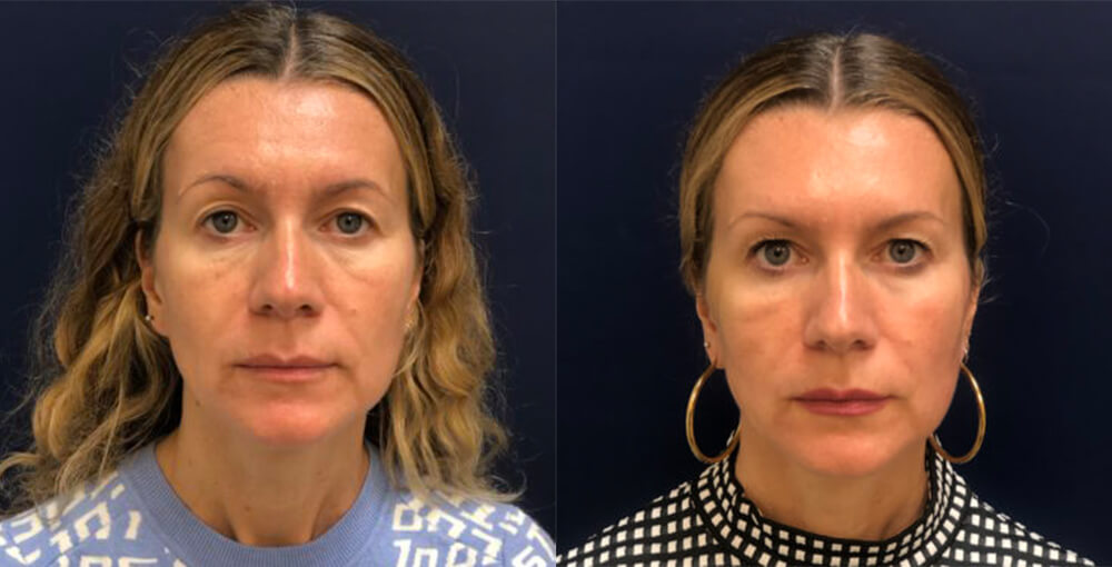 NovaThreadlift Before and After Photo by Rejuvalife Vitality Institute in Los Angeles