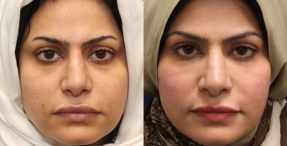 Fat transfer for face Before & After  - Rejuvalife Vitality Institute - Los Angeles