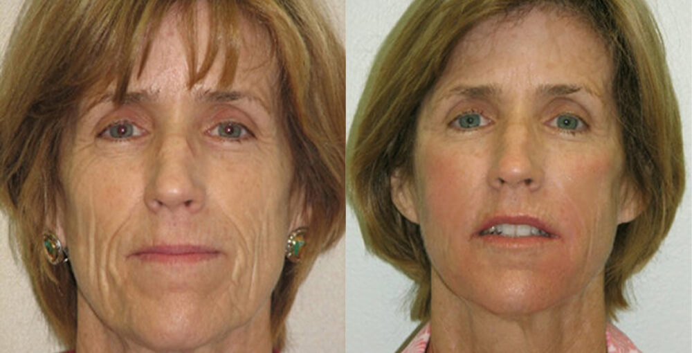 Smartlipo Lower Face Before and After Photo by Rejuvalife Vitality Institute in Beverly Hills