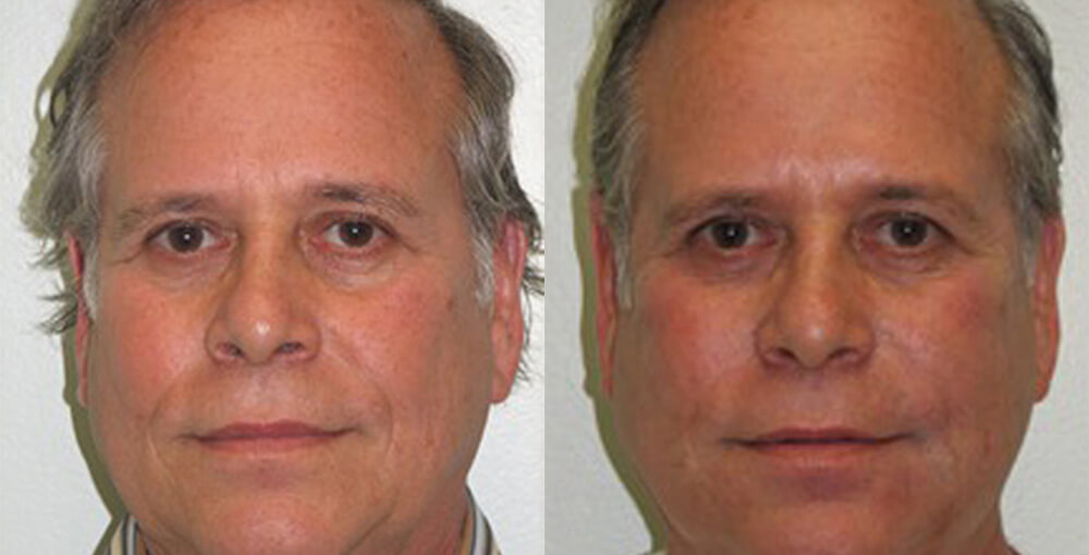 Dermal Fillers / Botox Before and After Photo by Rejuvalife Vitality Institute in Los Angeles