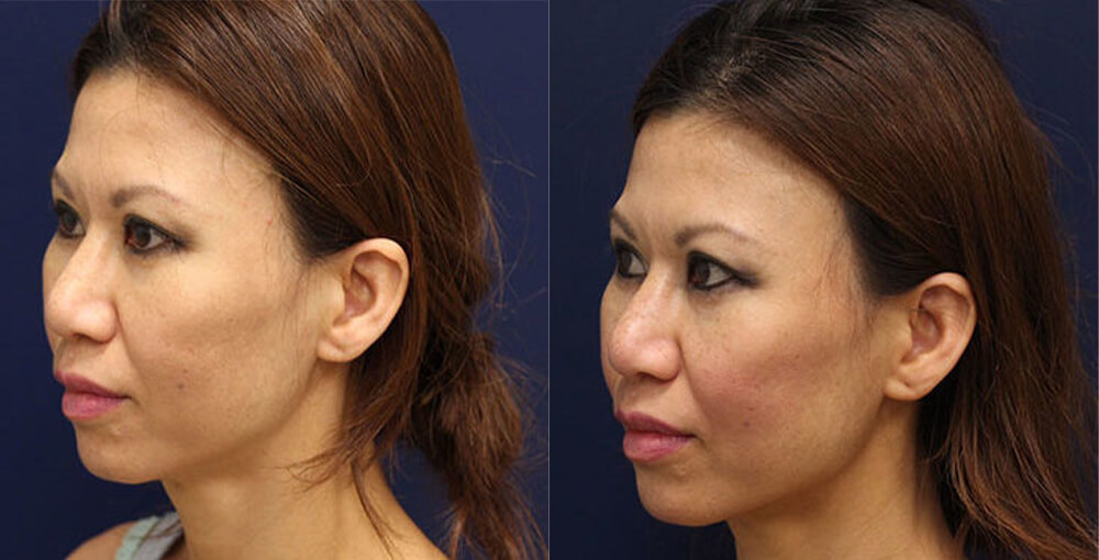 Dermal Fillers / Botox Before and After Photo by Rejuvalife Vitality Institute in Los Angeles