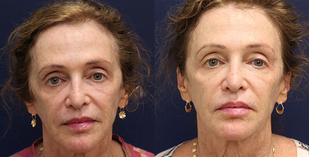 Bellafill Before and After Photo by Rejuvalife Vitality Institute in Los Angeles