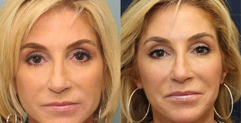 Lip Augmentation Before and After Photo by Rejuvalife Vitality Institute in Los Angeles