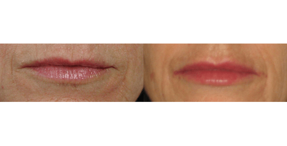 Lip Augmentation Before and After Photo by Rejuvalife Vitality Institute in Los Angeles