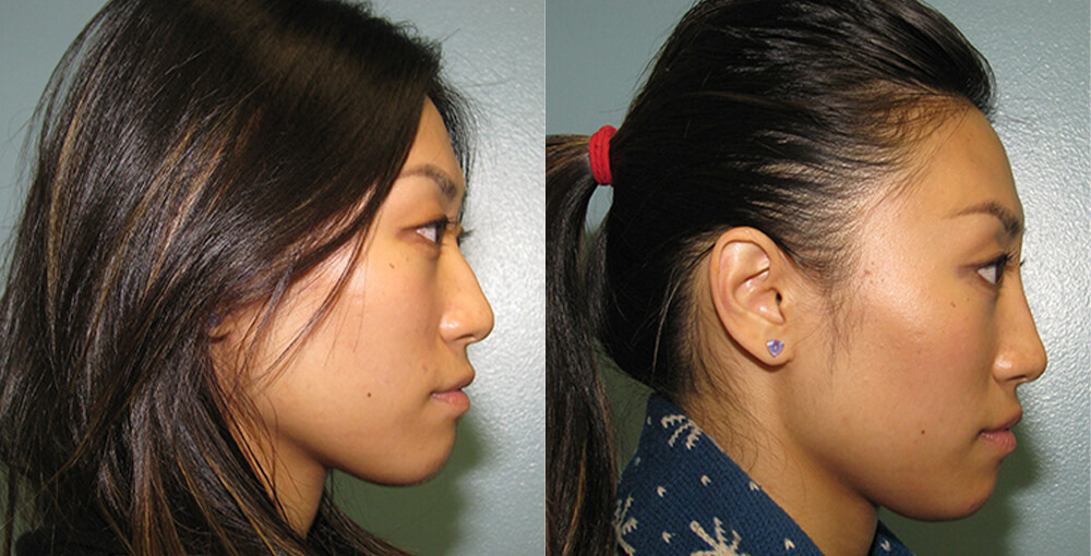 Non-Surgical Rhinoplasty Before and After Photo by Rejuvalife Vitality Institute in Los Angeles