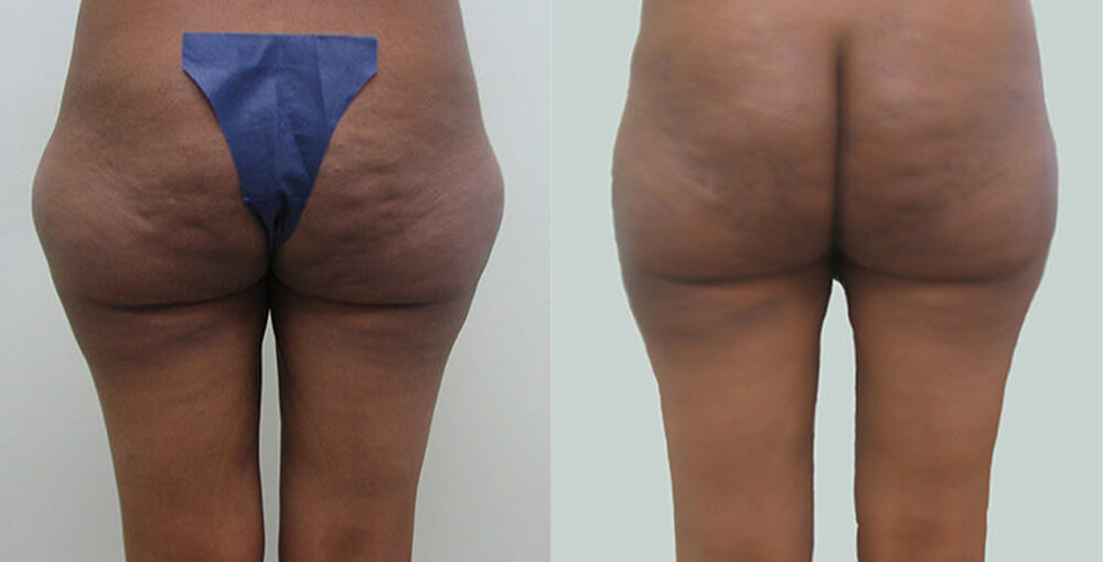 Cellulite Reduction and Cellulaze Before and After Photo by Rejuvalife Vitality Institute in Beverly Hills