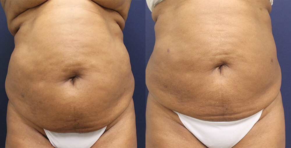 Liposuction / Smartlipo / Vaser Before and After Photo by Rejuvalife Vitality Institute in Los Angeles