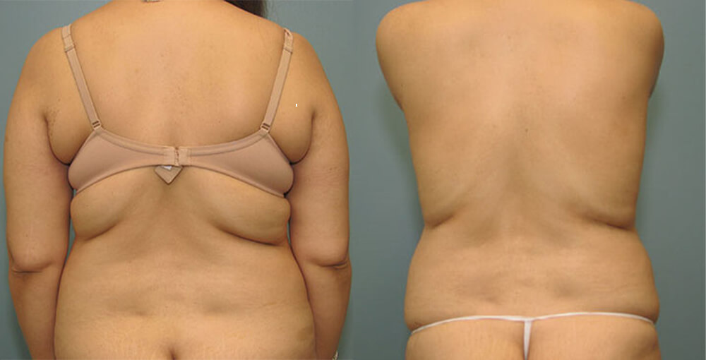 Liposuction / Smartlipo / Vaser Before and After Photo by Rejuvalife Vitality Institute in Los Angeles
