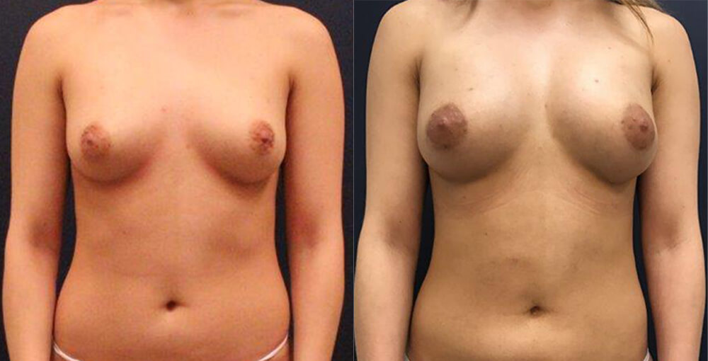 Natural Breast Augmentation Before and After Photo by Rejuvalife Vitality Institute in Beverly Hills