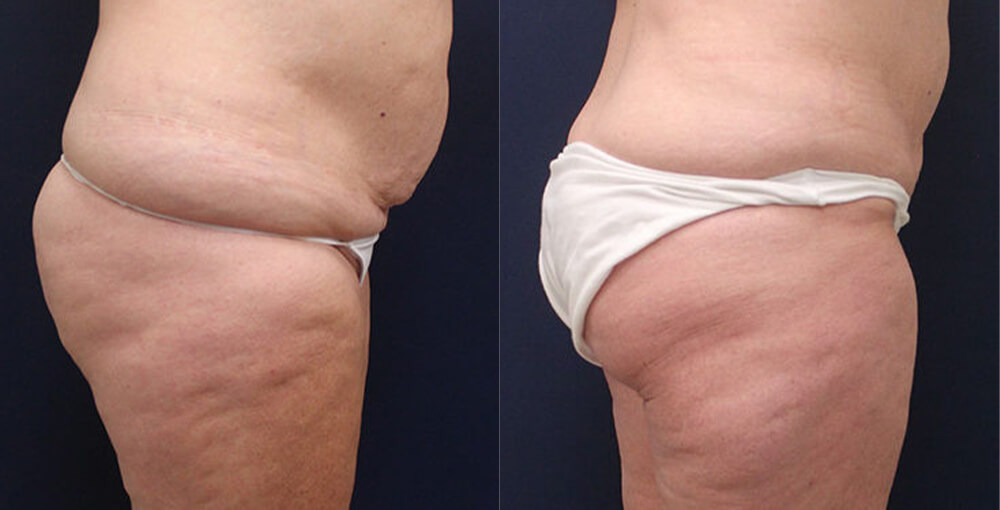 Body Sculpting (Abdomen / Flanks) Before and After Photo by Rejuvalife Vitality Institute in Los Angeles