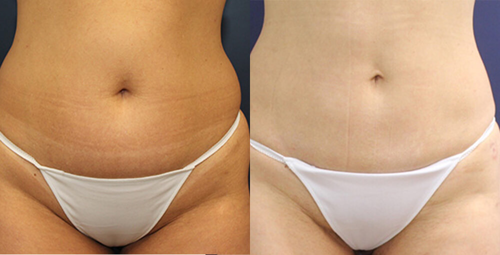 Body Sculpting (Abdomen / Flanks) Before and After Photo by Rejuvalife Vitality Institute in Los Angeles