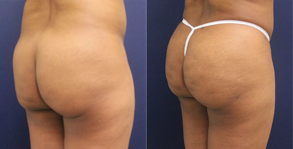 Brazilian Butt Lift Before and After Photo by Rejuvalife Vitality Institute in Beverly Hills