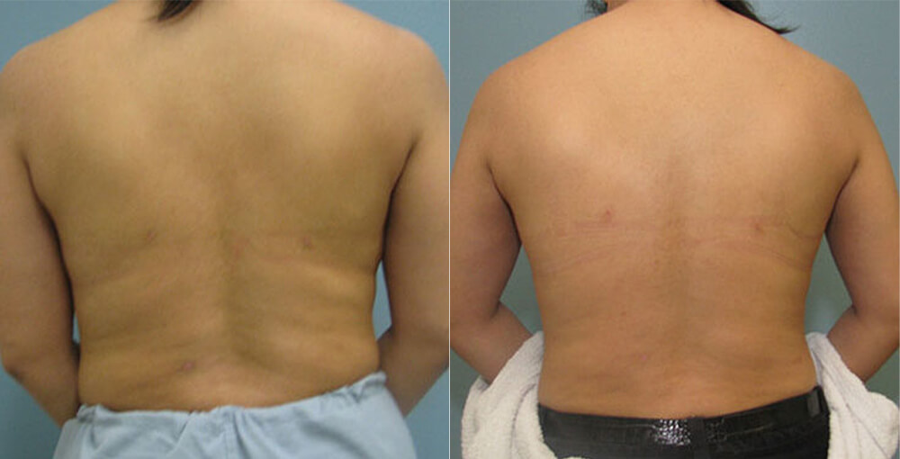 Body Sculpting (Back / Bra Bulges) Before and After Photo by Rejuvalife Vitality Institute in Los Angeles