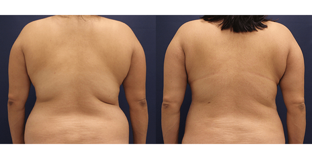 Body Sculpting (Back / Bra Bulges) Before and After Photo by Rejuvalife Vitality Institute in Los Angeles