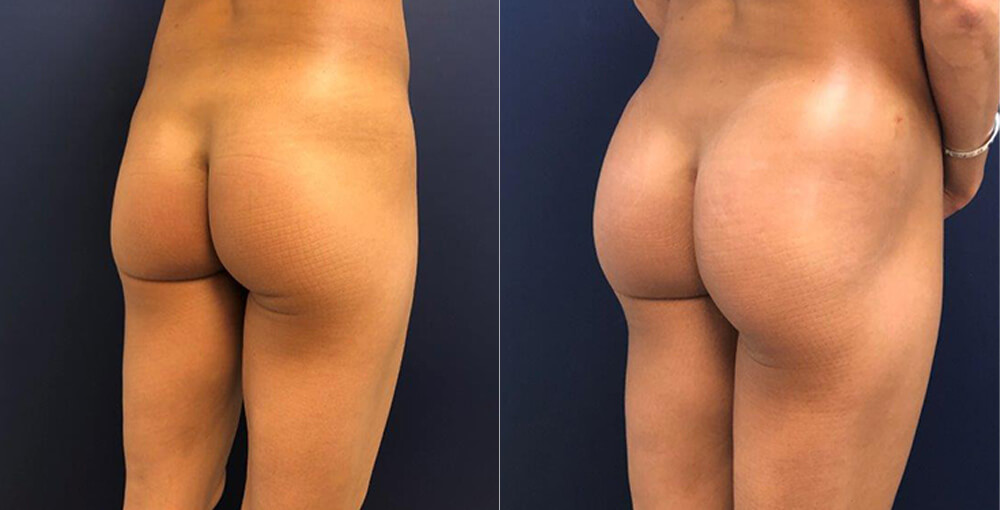 Sculptra Butt Lift Before and After Photo by Rejuvalife Vitality Institute in Beverly Hills