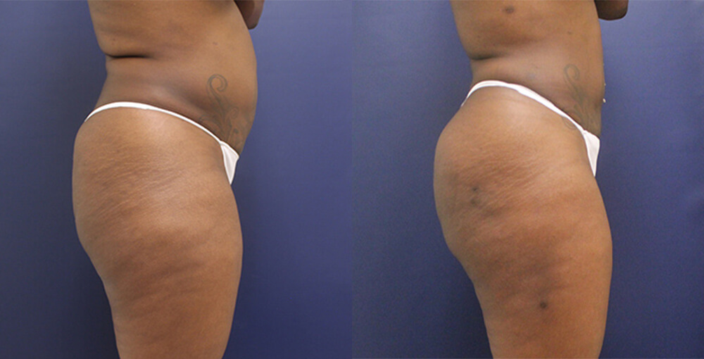 Fat Transfer Before and After Photo by Rejuvalife Vitality Institute in Beverly Hills Fat Transfer Before and After Photo by Rejuvalife Vitality Institute in Beverly Hills