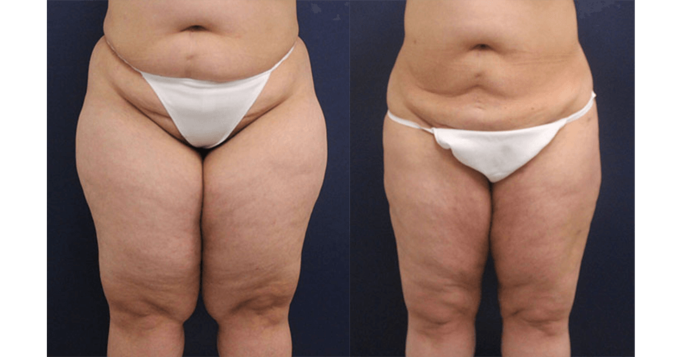 Liposuction / Smartlipo / VASER Before and After Photo by Rejuvalife Vitality Institute in Beverly Hills