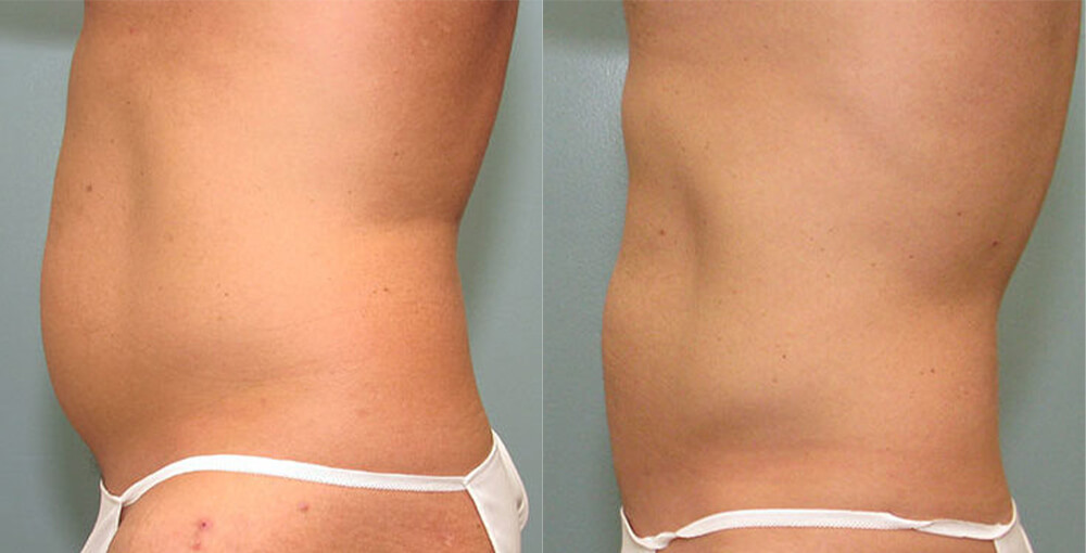 Male Body Sculpting Before and After Photo by Rejuvalife Vitality Institute in Los Angeles