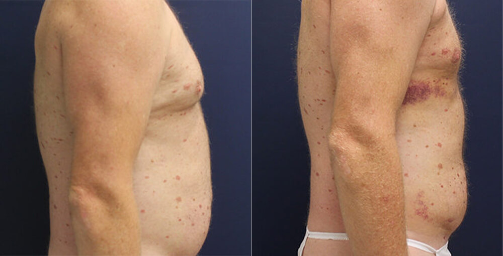 Male Body Sculpting Before and After Photo by Rejuvalife Vitality Institute in Los Angeles