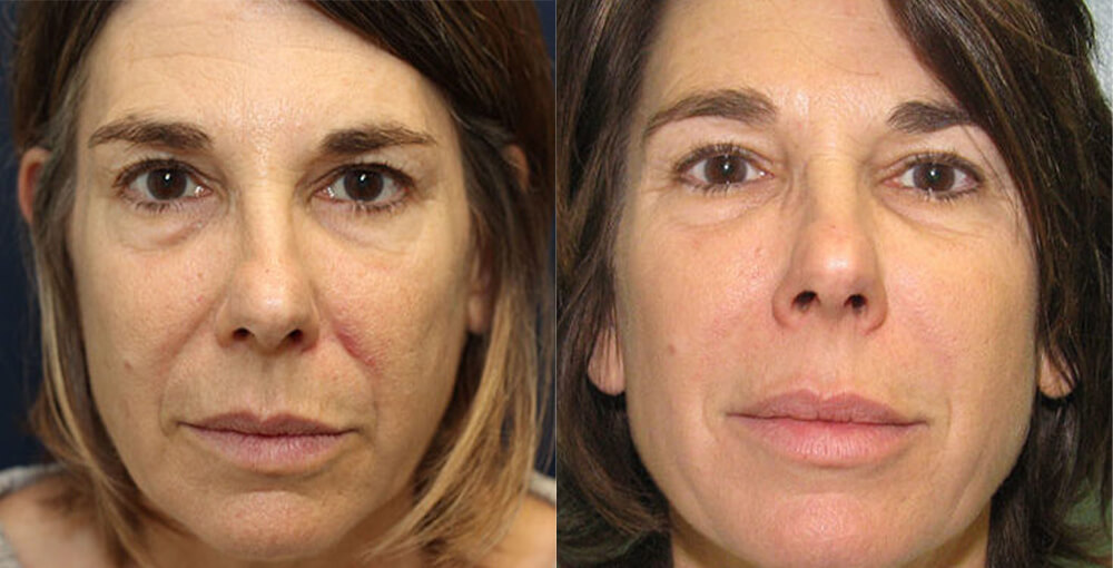 Juvederm Before and After Photo by Rejuvalife Vitality Institute in Los Angeles
