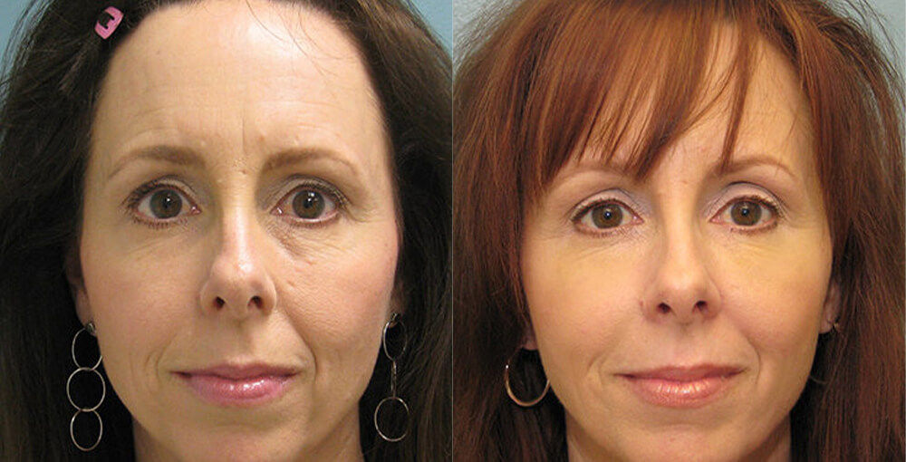 Juvederm Before and After Photo by Rejuvalife Vitality Institute in Los Angeles