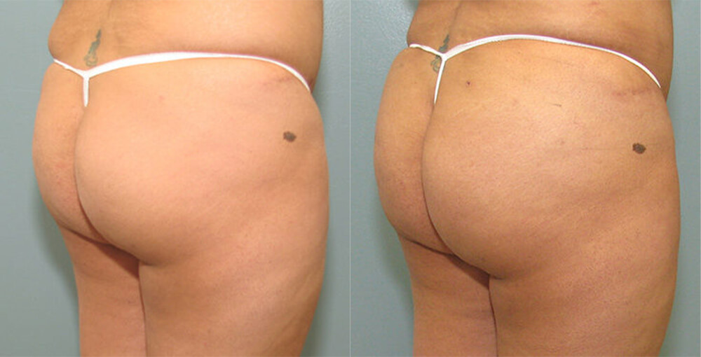 Brazilian Butt Lift Before and After Photo by Rejuvalife Vitality Institute in Los Angeles