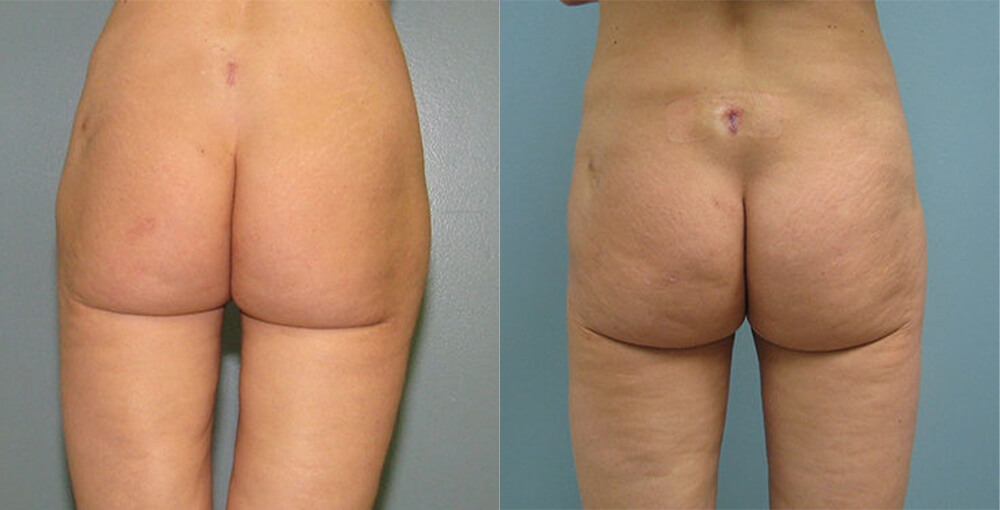 Brazilian Butt Lift Before and After Photo by Rejuvalife Vitality Institute in Los Angeles