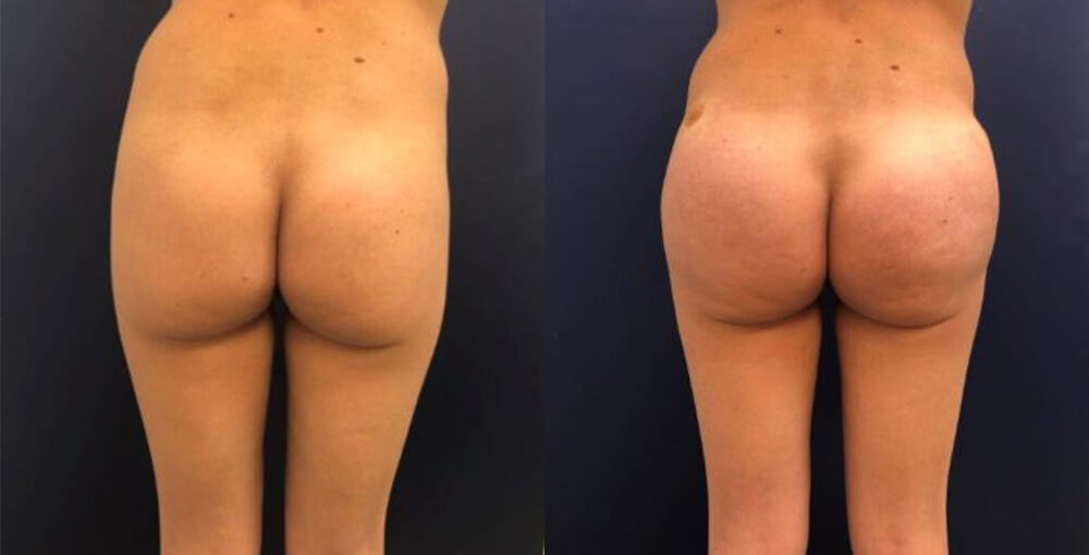 Sculptra Butt Lift Before and After Photo by Rejuvalife Vitality Institute in Los Angeles