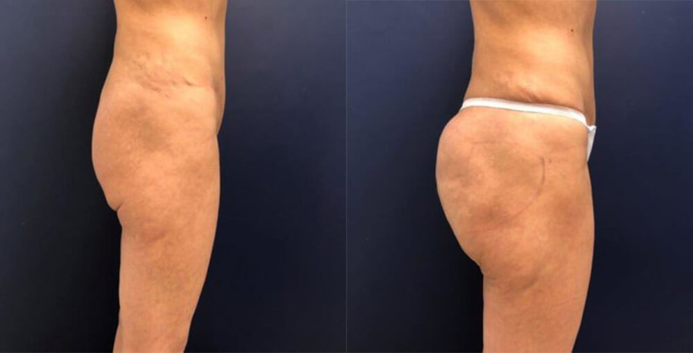 Sculptra Butt Lift Before and After Photo by Rejuvalife Vitality Institute in Los Angeles