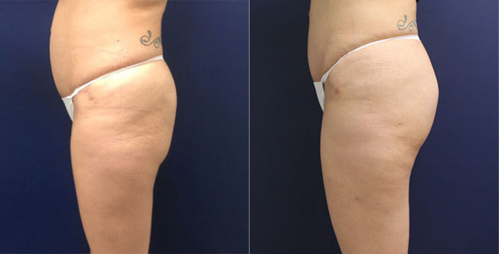 Body Fat Transfer Before and After Photo by Rejuvalife Vitality Institute in Los Angeles
