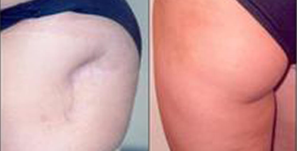 Body Fat Transfer Before and After Photo by Rejuvalife Vitality Institute in Los Angeles