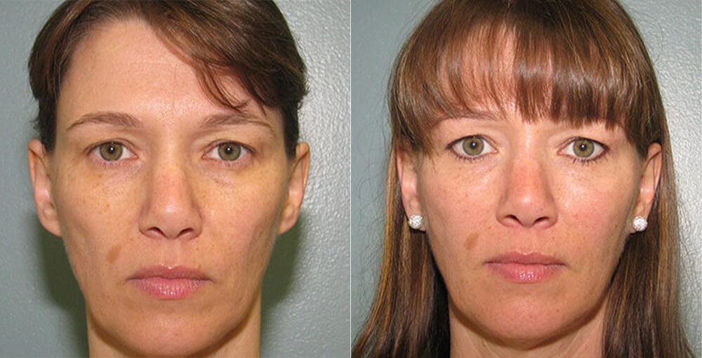 Fat transfer for face Before & After - Rejuvalife Vitality Institute - Los Angeles