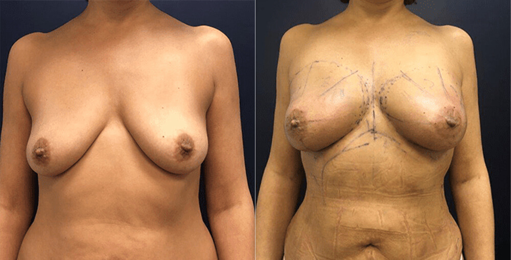 Natural Breast Augmentation Before and After Photo by Rejuvalife Vitality Institute in Los Angeles