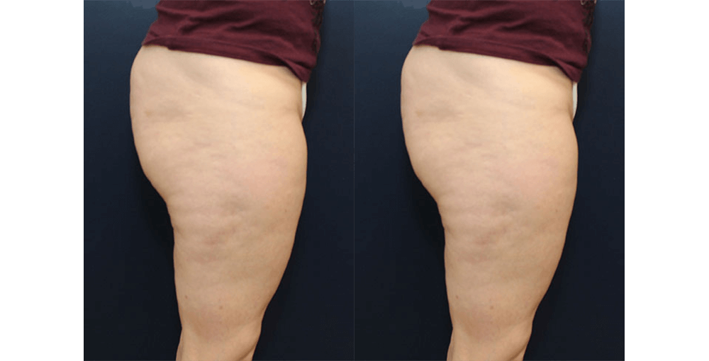 Cellulite Reduction & Cellulaze Before and After Photo by Rejuvalife Vitality Institute in Los Angeles