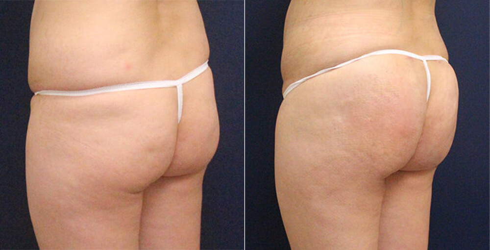 Silhouette Buttlift with Threads Before and After Photo by Rejuvalife Vitality Institute in Los Angeles
