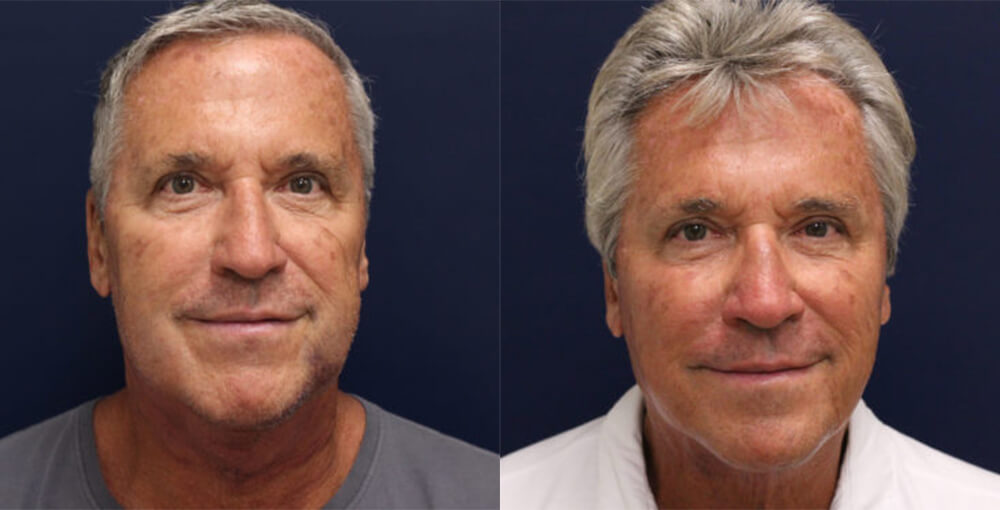 Threadlifts Before and After Photo by Rejuvalife Vitality Institute in Beverly Hills