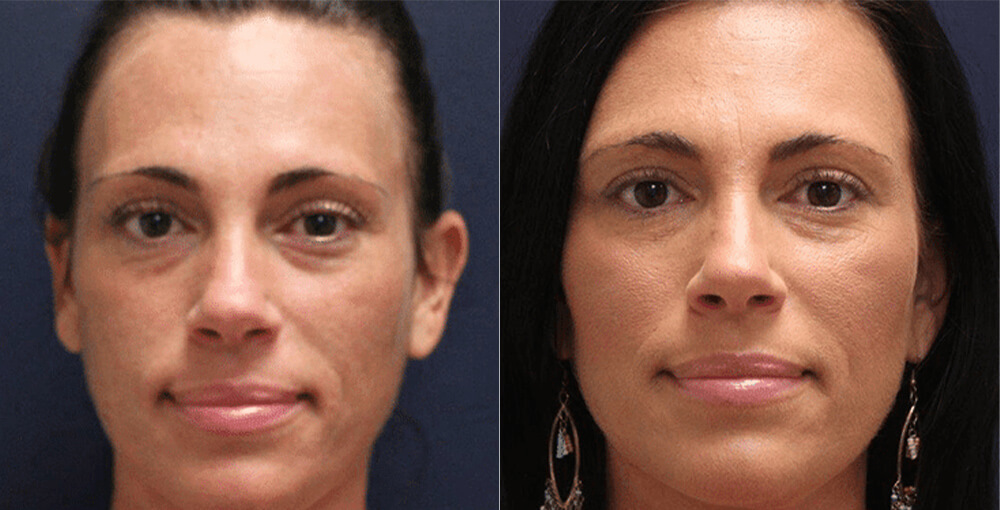 Fat transfer for face Before & After - Rejuvalife Vitality Institute - Los Angeles